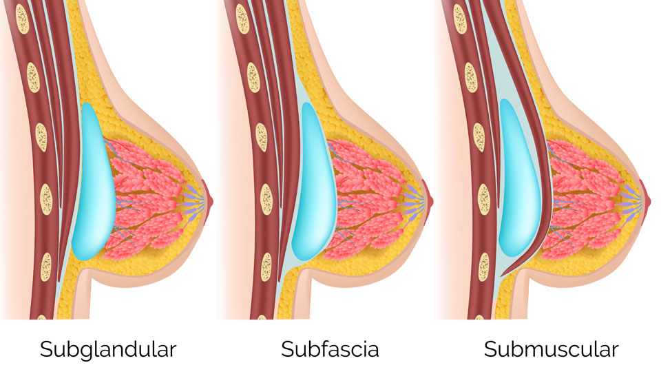 Mamoplastia de aumento de senos Cirugía Plástica Dra Carmen Huertas Cirujano Plástico;